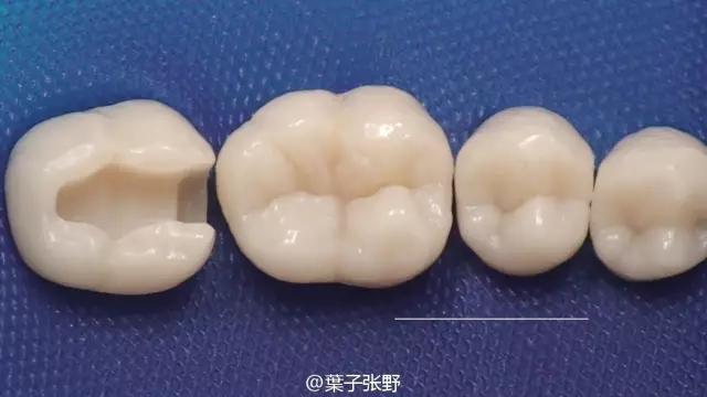 补牙疼吗补牙过程图,补牙全部过程是什么样子的