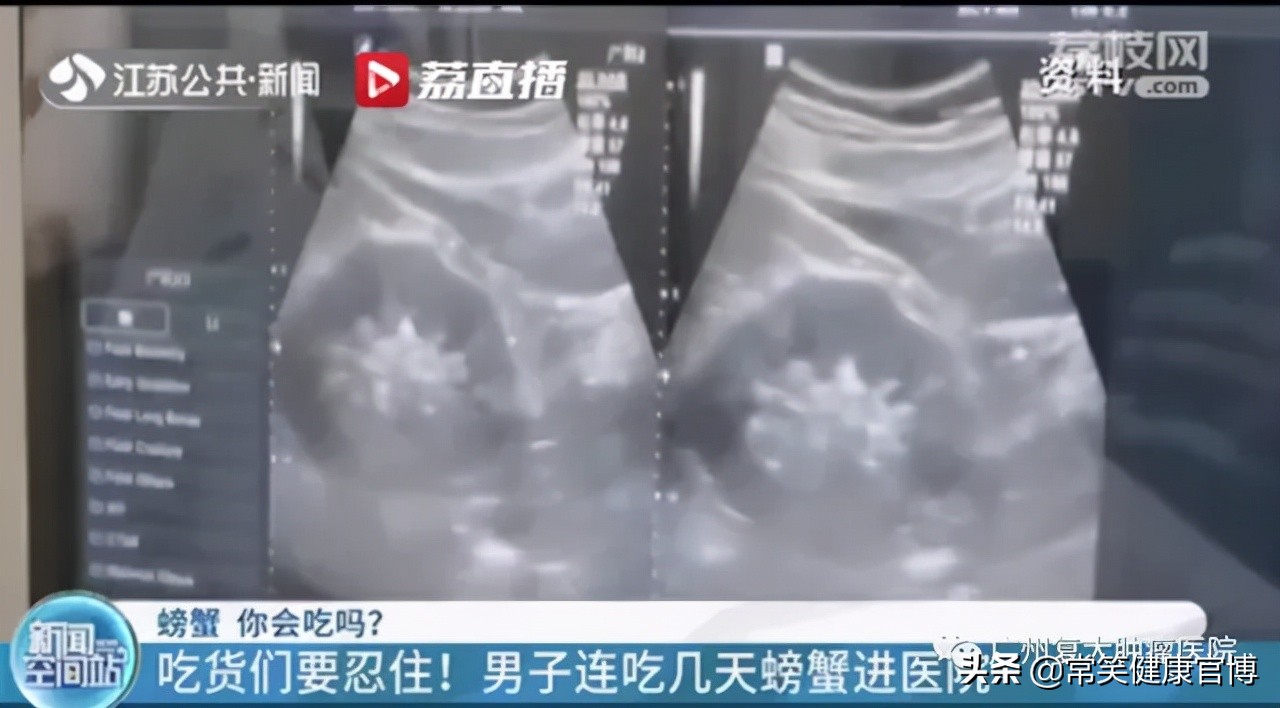 患过胆结石的人能吃螃蟹吗,男子吃多螃蟹竟引发如此悲剧