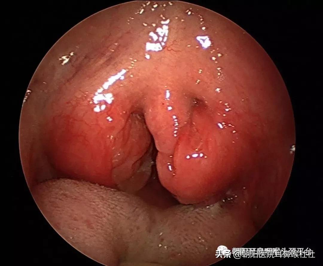 得了扁桃体癌的时候扁桃体红吗,扁桃体癌或扁桃体恶性淋巴瘤