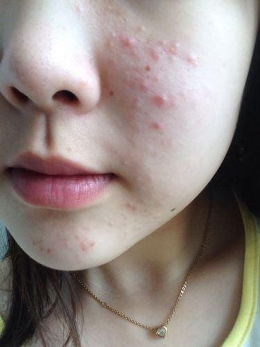 痘痘爆发季告诉你痘痘的形成原因,痘痘长期存在总是爆痘怎么办