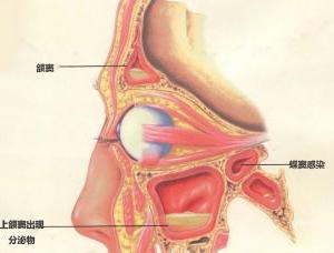 眼睛早上起来肿是什么眼疾,眼疾出现5大妙招帮你应对