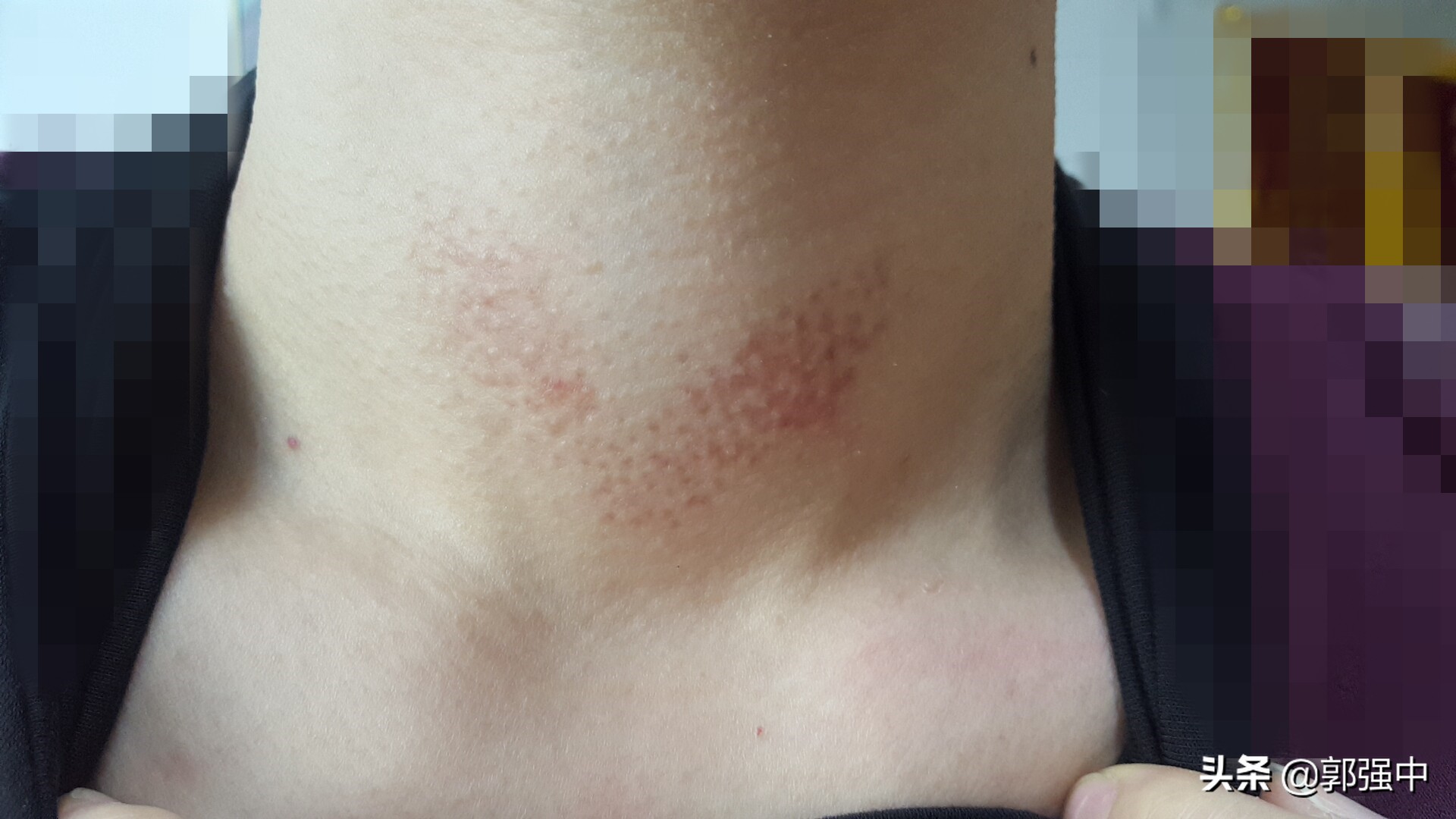 甲状腺肿大吃药没用，咋办？