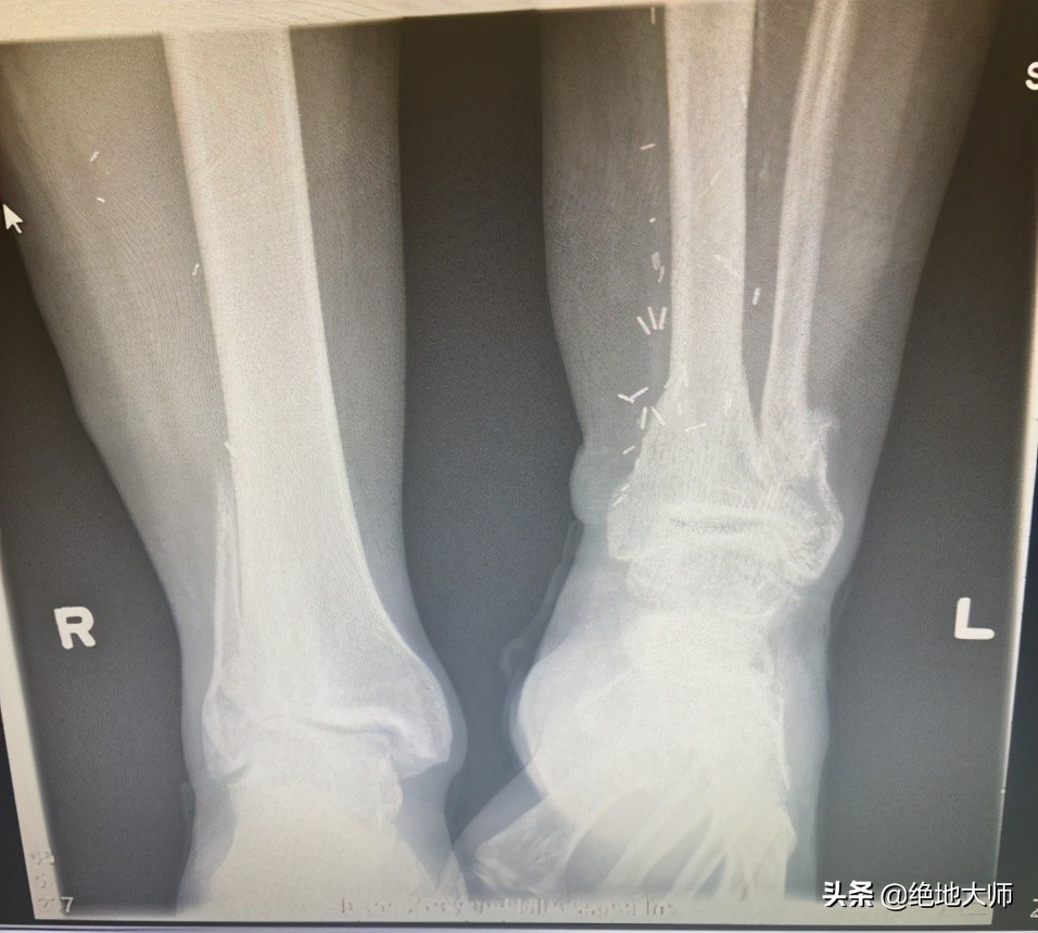 腿长短不一样怎么诊断,腿长短不一怎么调理