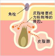 毛孔堵塞用水杨酸果酸泥膜好吗,果酸水杨酸护肤品推荐收缩毛孔