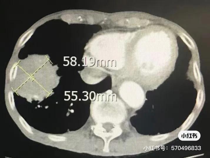 冷冻针治肿瘤能活多久,一根细针可以消除肿瘤