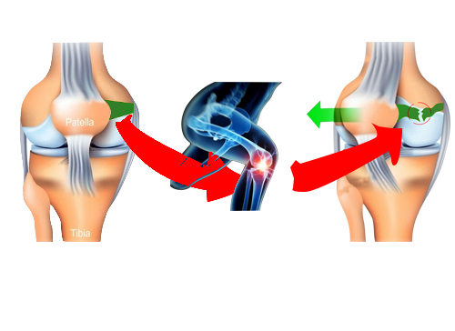 髌骨半脱位关节镜微创手术,髌骨脱位二联手术