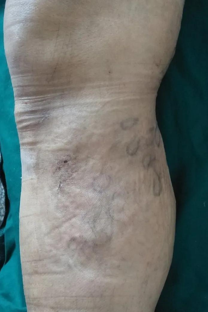 河北静脉曲张微创手术,邢台静脉曲张手术多长时间治好