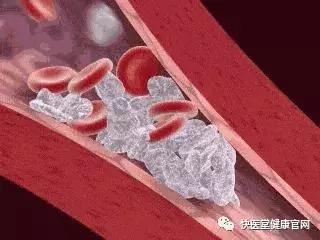 缺血预适应训练方法和作用,缺血预适应训练促进血管再生