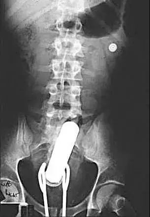 进去容易出来难:直肠异物,问题比“丢人”严重得多