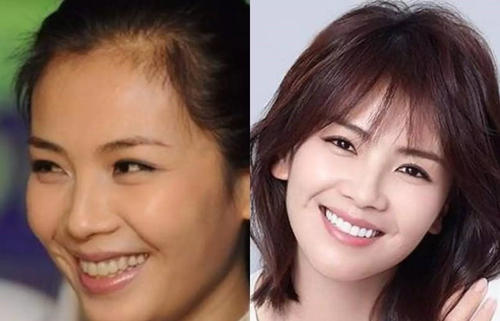 吴宣仪烤瓷牙怎么做,吴宣仪的整牙前