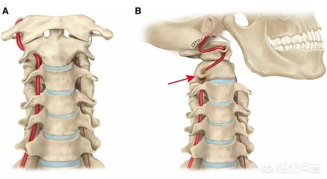 治疗颈椎病眩晕的药物,颈椎病疼痛麻严重吗怎么治疗