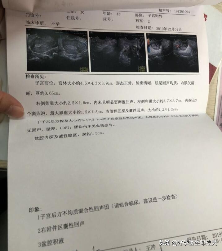 月经淋漓不断一个月，盆腔有5公分包块，这种疾病医生容易误诊