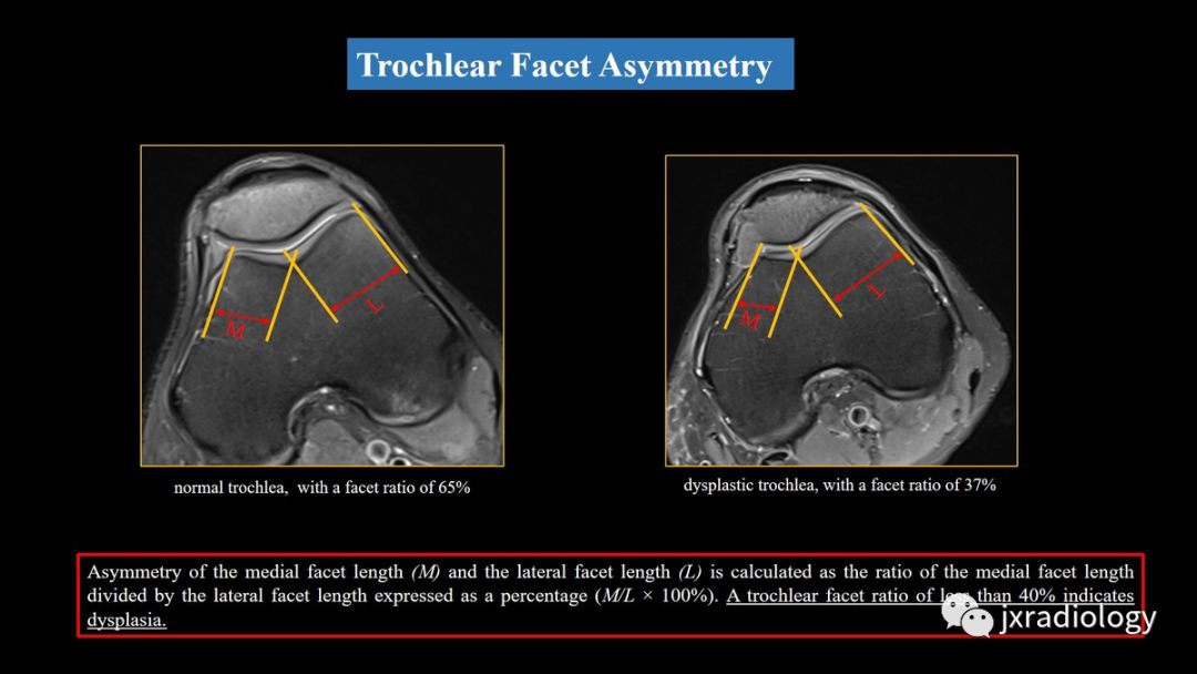 髌股关节失常磁共振看什么,髌股关节混乱的影像评估