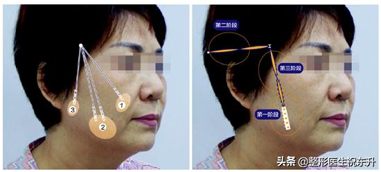 对比常做的几个面部提升项目,祝大夫面部提升
