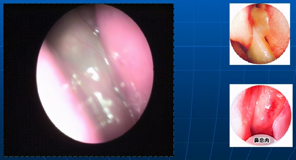 鼻息肉引起的鼻塞和嗅觉减退,感冒会引起鼻息肉鼻塞吗