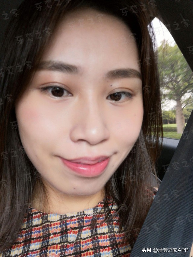 拔牙和打骨钉哪个更痛,矫正牙齿拔牙后一定要打骨钉吗