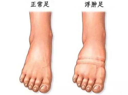 小便没泡沫是不是肾脏就没问题,尿中有泡沫你的肾脏真的病了吗