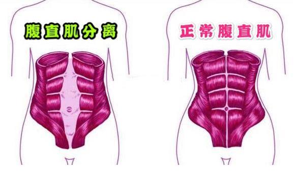 产后腹直肌分离怎么练最有效最快,腹直肌分离怎么恢复视频