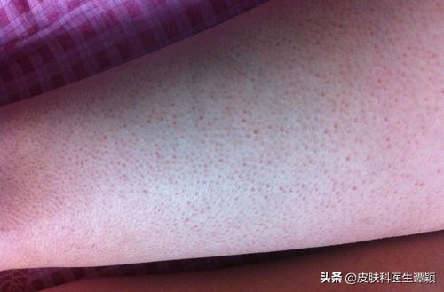 去医院皮肤科能治鸡皮肤吗,皮肤科医生鸡皮
