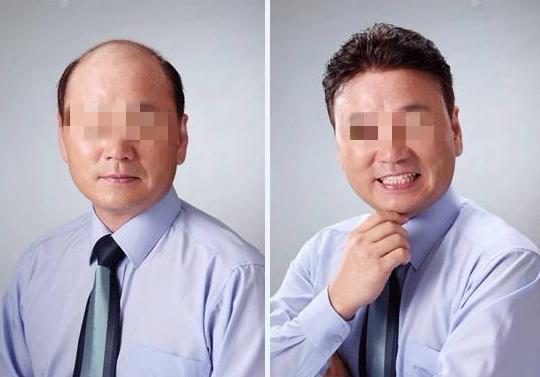 天津美丝特科技增发中心韩医生给您介绍关于织发补发的事情