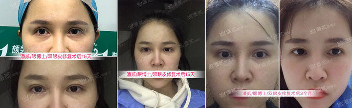 双眼皮离眉毛太近还能修复好吗,割双眼皮眉毛下面肿会消肿吗