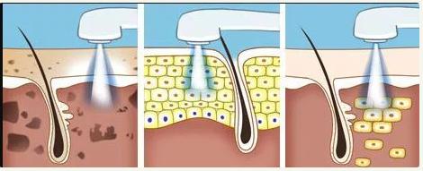 m22光子嫩肤的功效和作用,m22光子嫩肤的功效和作用价格