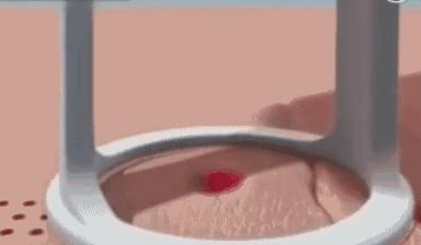 夏天疤痕治疗怎么做,多年疤痕秋冬疤痕痒怎么消除