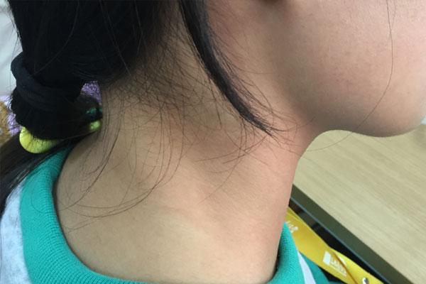 皮肤长小肉粒怎样去除用什么药,脖子皮肤表面的小肉粒是什么