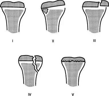 所有骨折都叫什么名字,骨折的名称有哪些