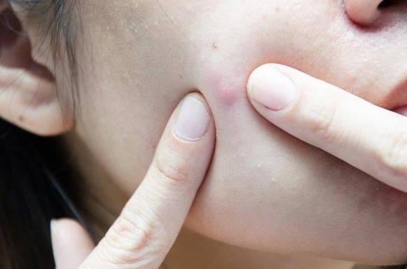 爱长痘的姐妹看过来,爱长痘的女生用什么水乳