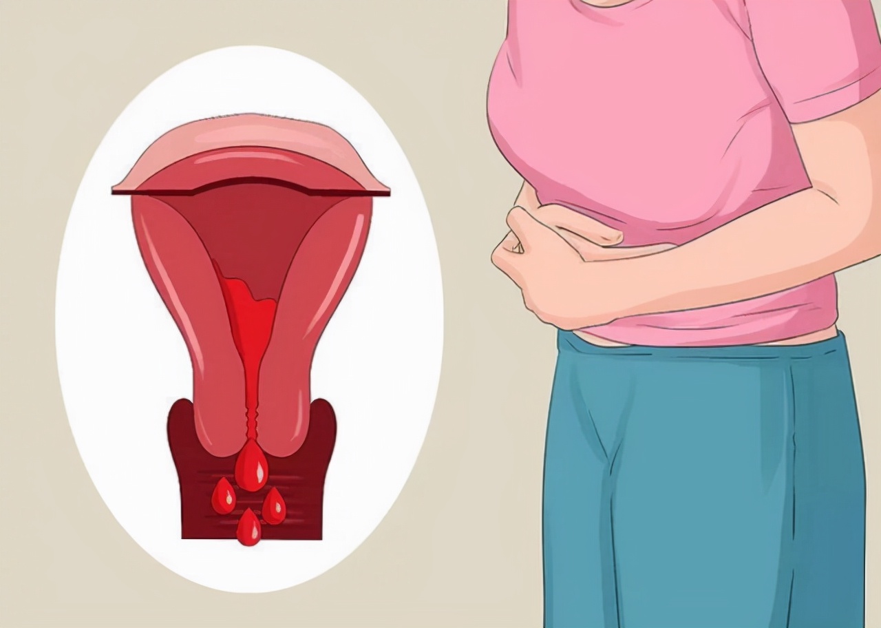 女性来例假为什么会有血疙瘩,经期排出很大很大的血块像肉一样