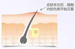 痘痘不去挤变疤痕疙瘩,痘痘不去挤变黑了怎么办