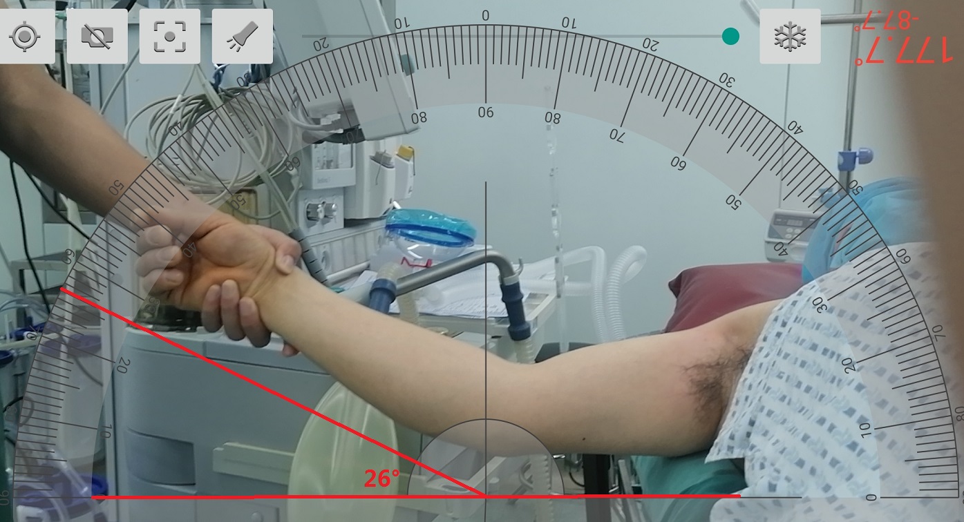 肘关节僵硬手术松解后一直有积液,肘关节僵硬异位骨化必须做松解吗