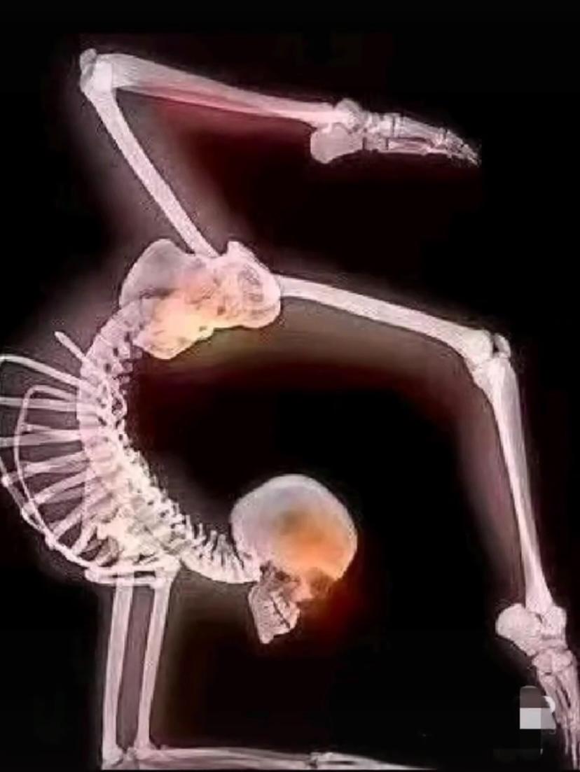 小孩学舞蹈瘫痪的案例,5岁女孩练舞蹈导致瘫痪