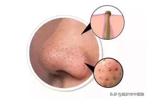 春夏之交，黑头来袭？这才是正确祛除黑头的打开方式！