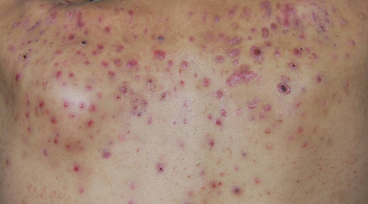 背上痘痘太多,背上长痘痘解决小妙招医生