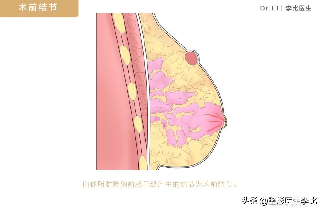隆胸半年之后胸部有囊肿正常吗,脂肪隆胸以后胸部周围有小疙瘩