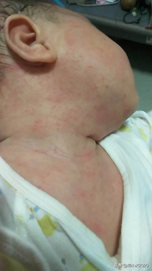 宝宝湿疹红屁股该怎么办,没出满月的宝宝湿疹还有红屁股