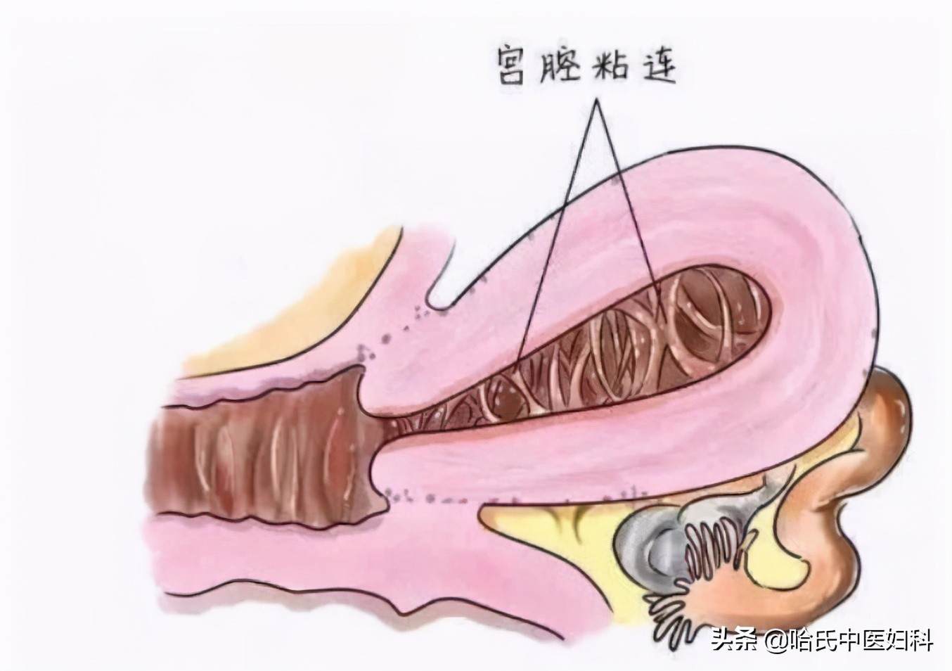 29岁输卵管堵塞怀孕,结婚流产一回会输卵管堵吗
