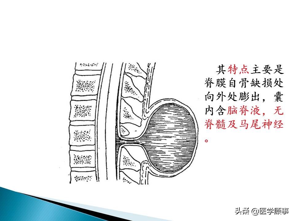 先天性脊柱裂是怎么来的,先天性脊柱裂的孕妇