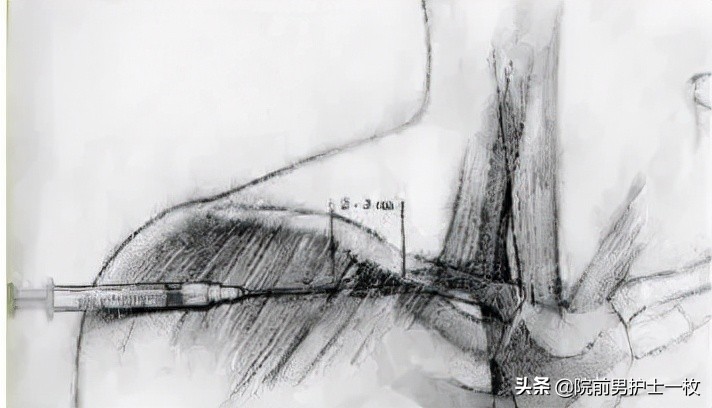 深静脉置管锁骨下静脉穿刺部位,深静脉穿刺置管拔出需要注意什么