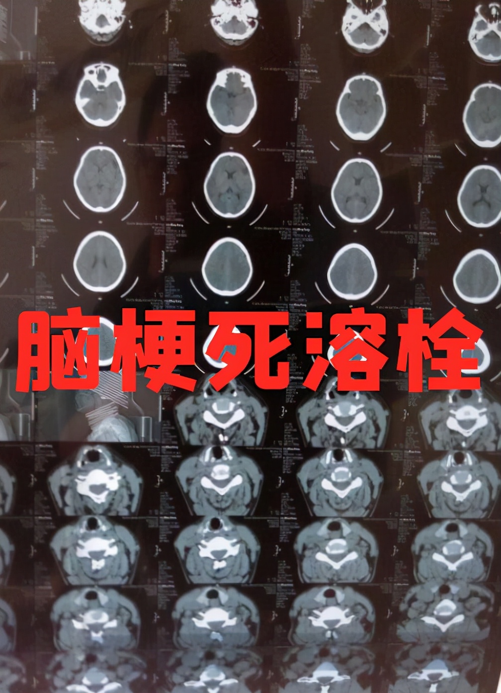 脑梗塞不要怕学会中医这招,治疗脑梗塞中风的中医偏方