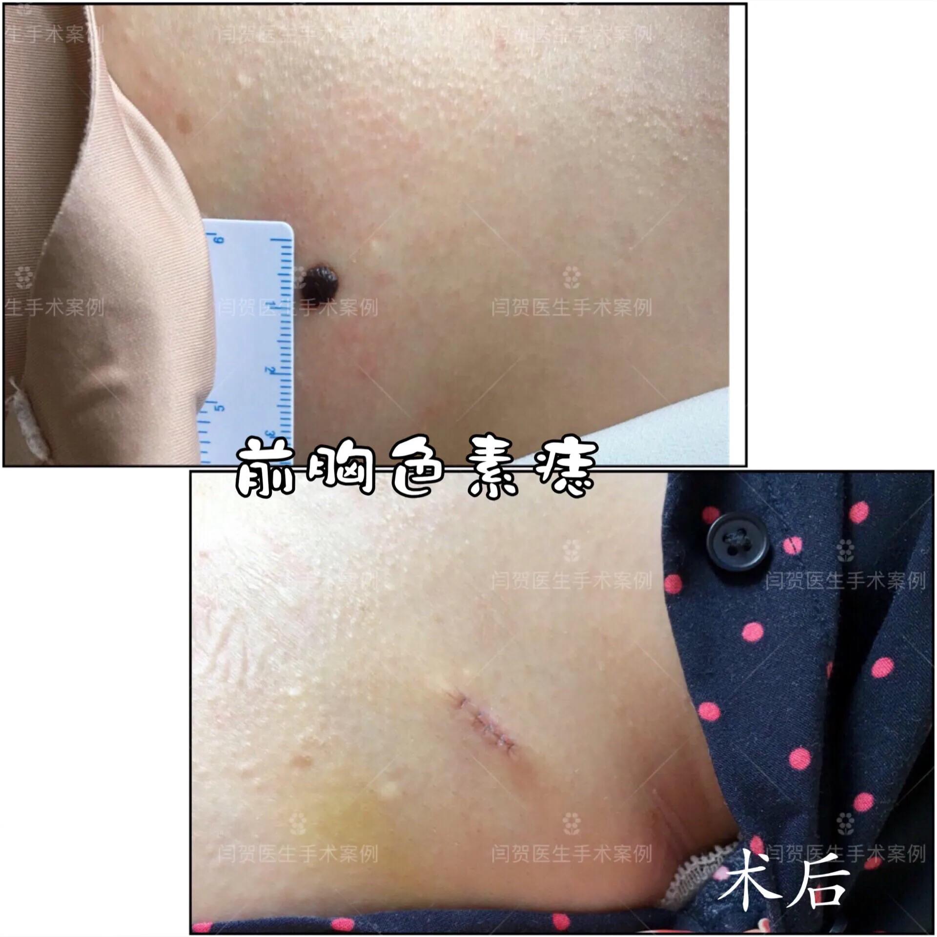 脚底有痣激光还是手术切除,黑色素痣手术切除还是激光去除好