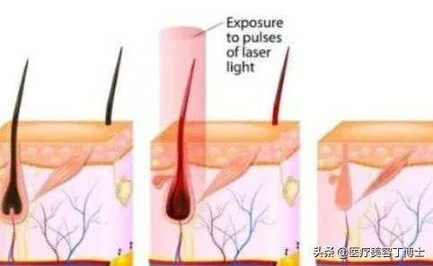 毛孔粗大皮肤又干是什么肤质,毛孔粗大的克星怎么解决