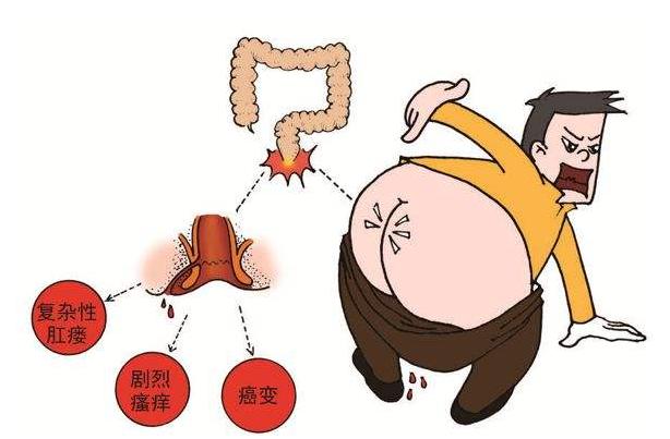 得了肛瘘不治疗会怎么样,肛瘘体验