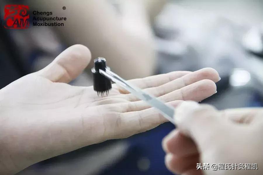 针灸治疗黄斑病变,视网膜黄斑变性的针灸治疗