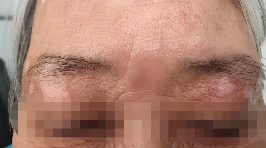 白癜风的正确看法,突然间长白癜风怎么回事