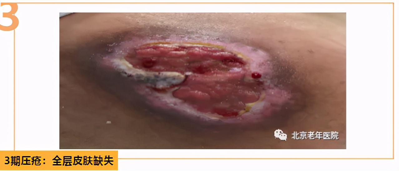 老年人防压疮的饮食照护原则,三度压疮老年人的家庭照护