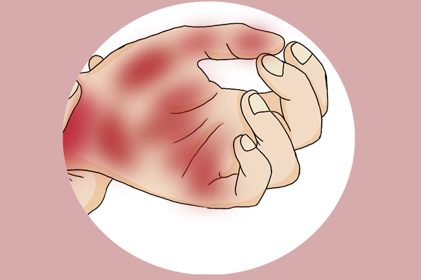 手掌上的肝掌是什么病,肝掌颜色是鲜红色吗