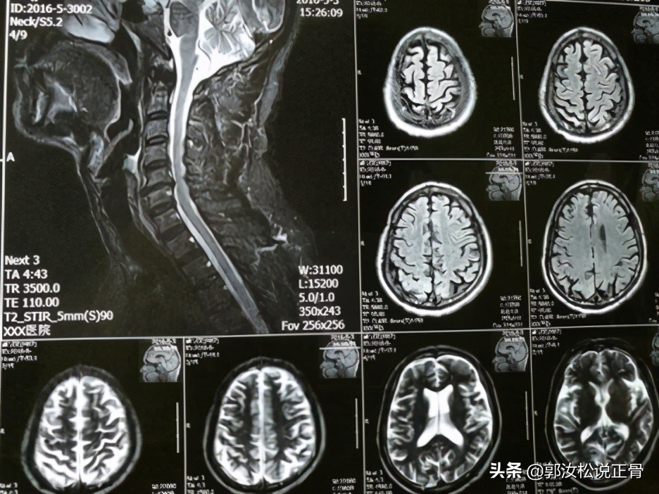 颈椎病引发头晕走路不稳怎么治,颈椎病引起头晕走路不稳怎么办